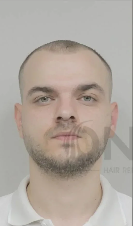 Onna Hair danışanının protez saç uygulaması öncesindeki hâli
