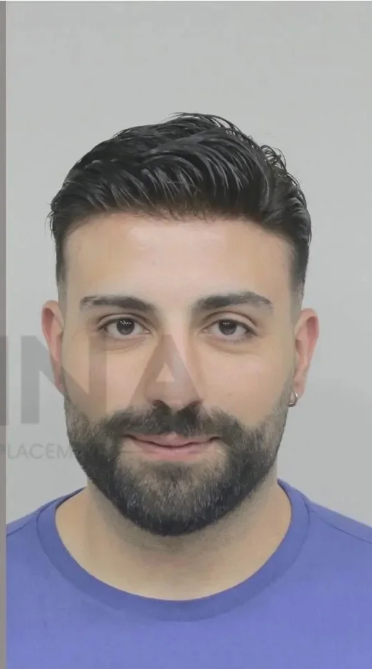 Erkek protez saç uygulaması yapılmış Onna Hair danışanı