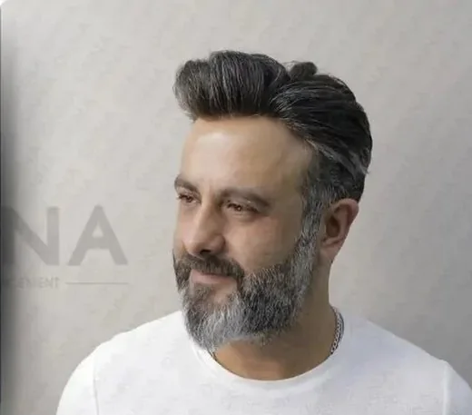 Erkek protez saç uygulaması yapılmış Onna Hair danışanı