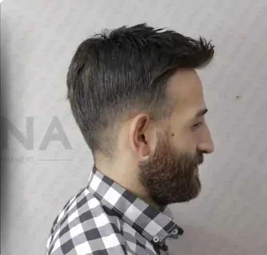 Erkek protez saç uygulaması yapılmış Onna Hair danışanı