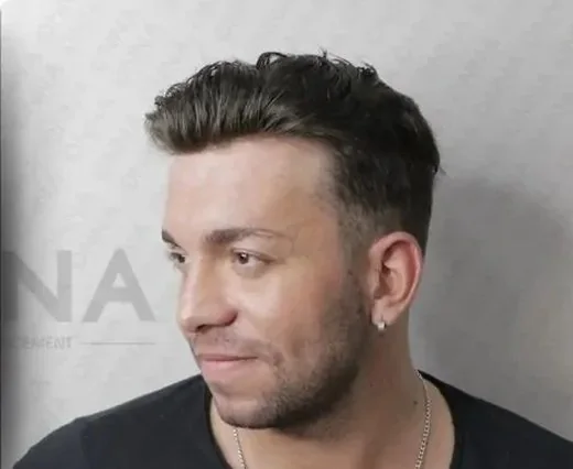 Erkek protez saç uygulaması yapılmış Onna Hair danışanı
