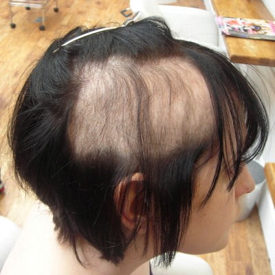 Trichotillomania (Hair Plucking Disease)