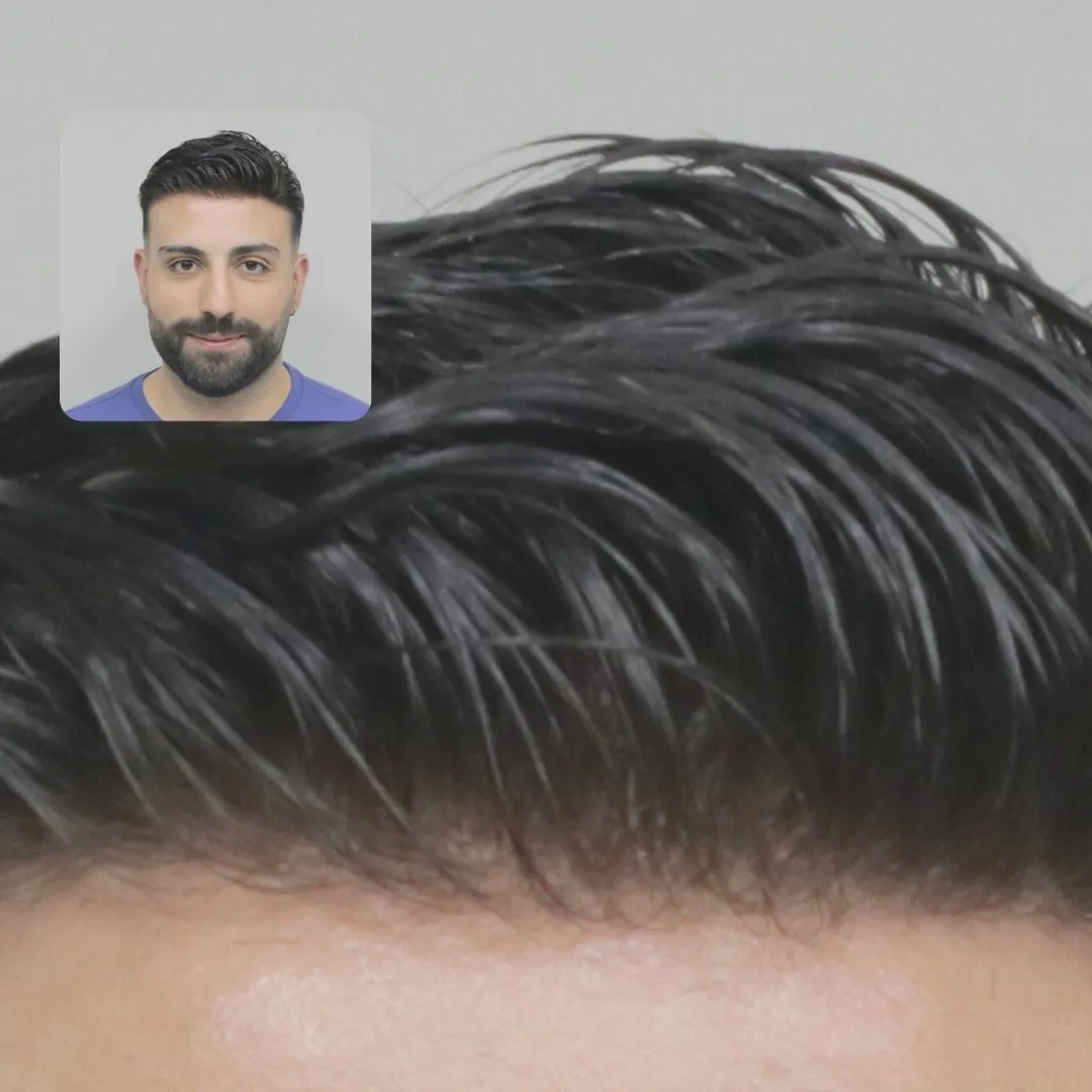 Protez Saçın Son Aşaması 2
