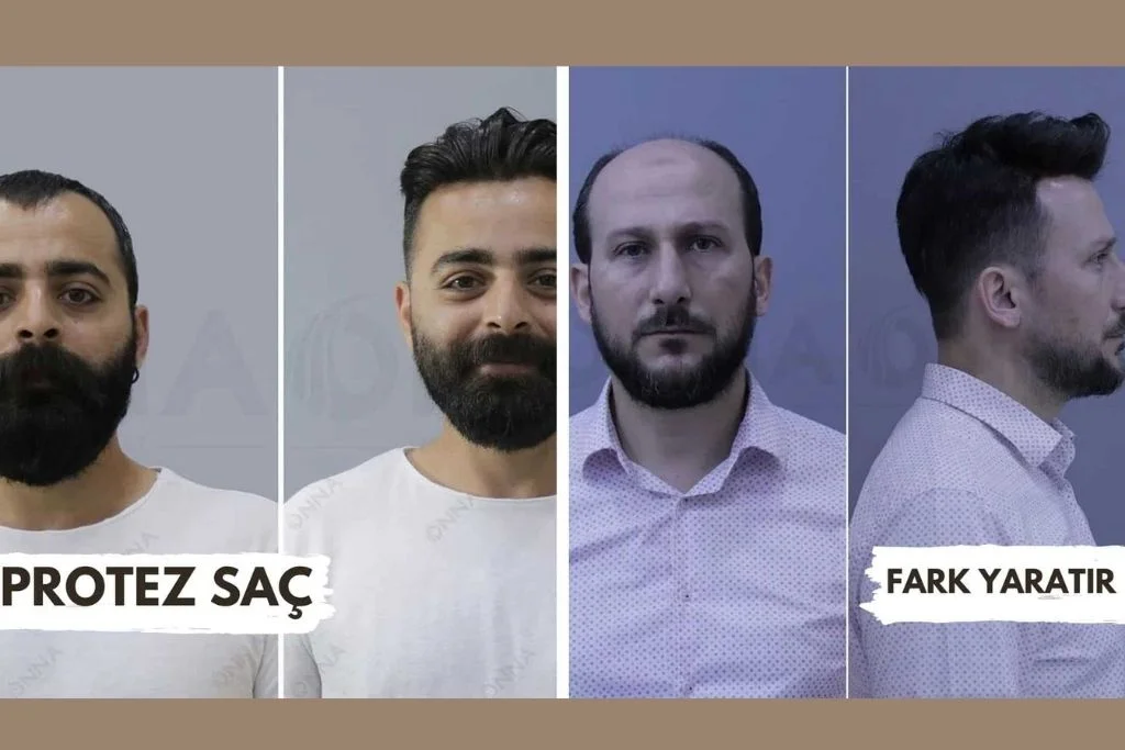 Protez Saç İnsanı Nasıl Değiştirir
