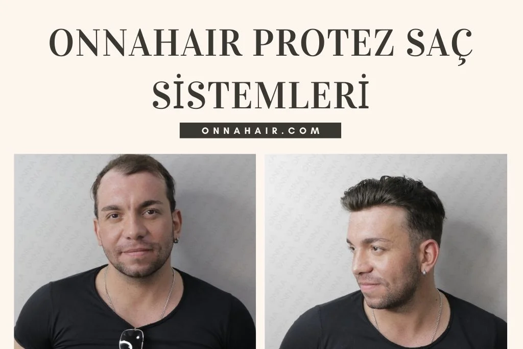 Kellik çözümü Için Protez Saç Ile Estetik Bir Dokunuş