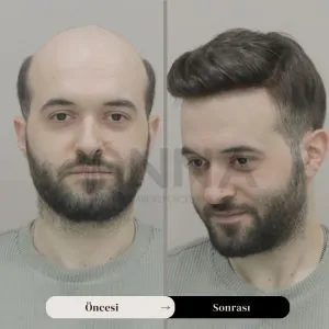 Protez Saç Stilleri Ve Modelleri