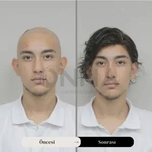 Protez Saç Stilleri Ve Modelleri