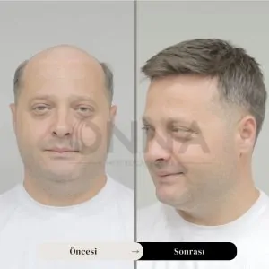 Protez Saç Stilleri Ve Modelleri