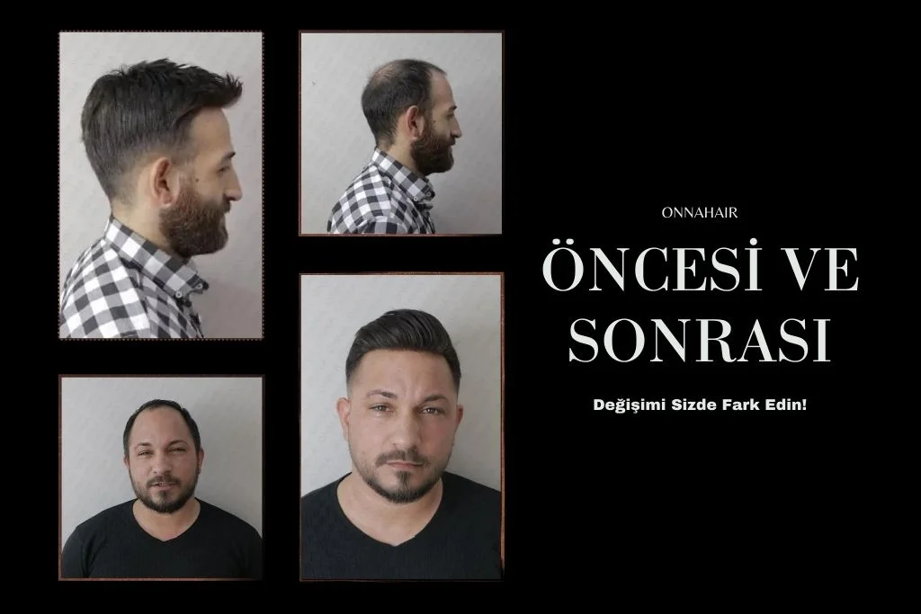 Protez Saç Sonucu Gerçek Kullanıcı Deneyimleri