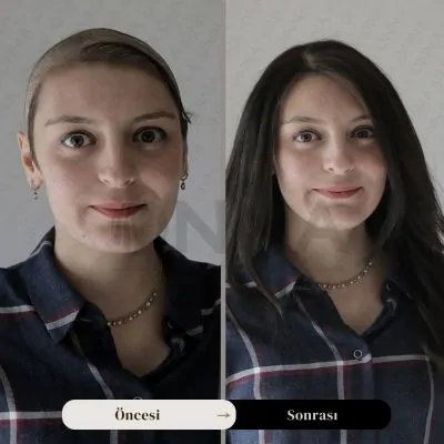Kadın Protez Saç öncesi Ve Sonrası
