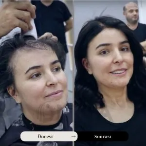 Kadın Protez Saç öncesi Ve Sonrası