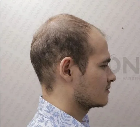 Onna Hair danışanı, protez saç uygulaması öncesi ve sonrası — öncesi