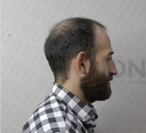 Sakallı danışanın protez saç uygulaması öncesi ve sonrası — öncesi