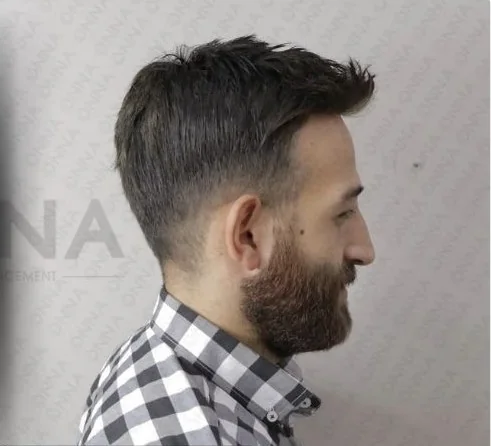 Sakallı danışanın protez saç uygulaması öncesi ve sonrası — sonrası