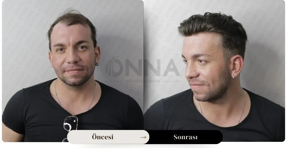 Protez Saç öncesi Ve Sonrası Resmi