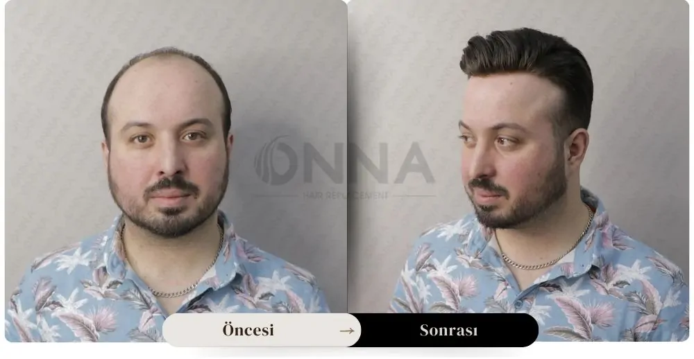 Protez Saç öncesi Ve Sonrası Resmi