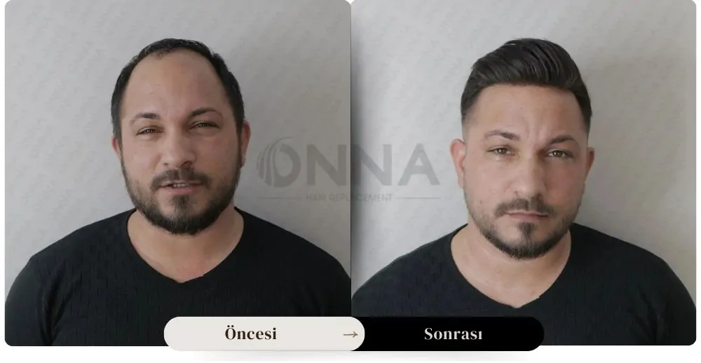 Protez Saç öncesi Ve Sonrası Resmi