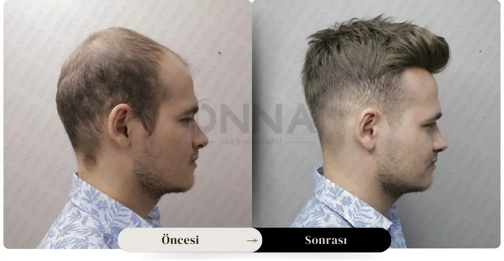 Protez Saç öncesi Ve Sonrası Resmi