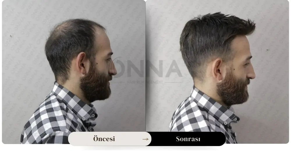 Protez Saç öncesi Ve Sonrası Resmi