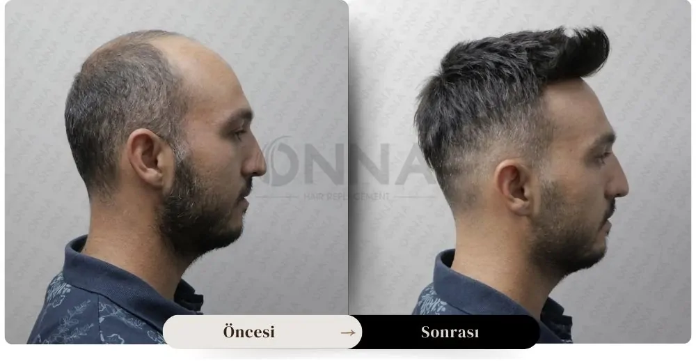 Protez Saç öncesi Ve Sonrası Resmi