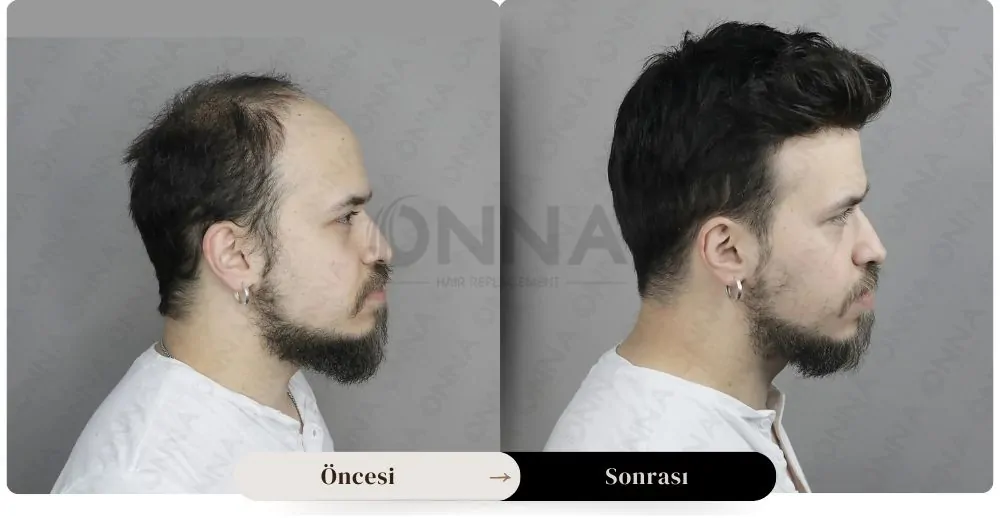 Protez Saç öncesi Ve Sonrası Resmi
