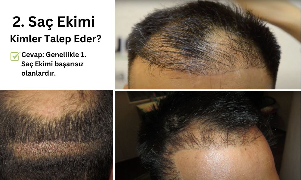 Başarısız saç ekimi